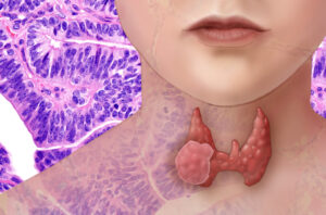 How do you naturally improve thyroid performance?